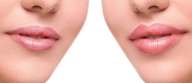 Filler Labbra Milano