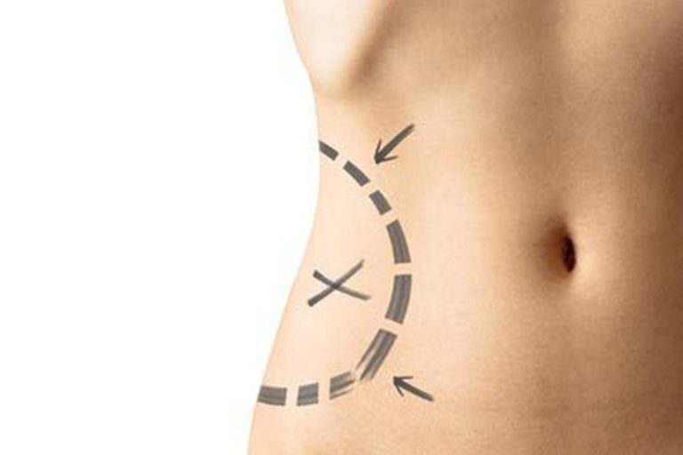 Liposuzione Roma Liposuzione Roma