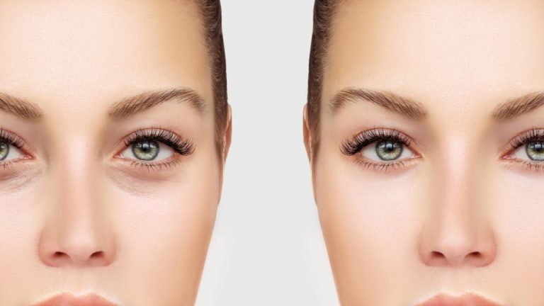 Blefaroplastica superiore Milano Blefaroplastica superiore Milano