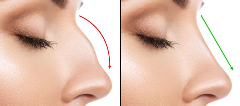 Preventivo rinofiller Milano