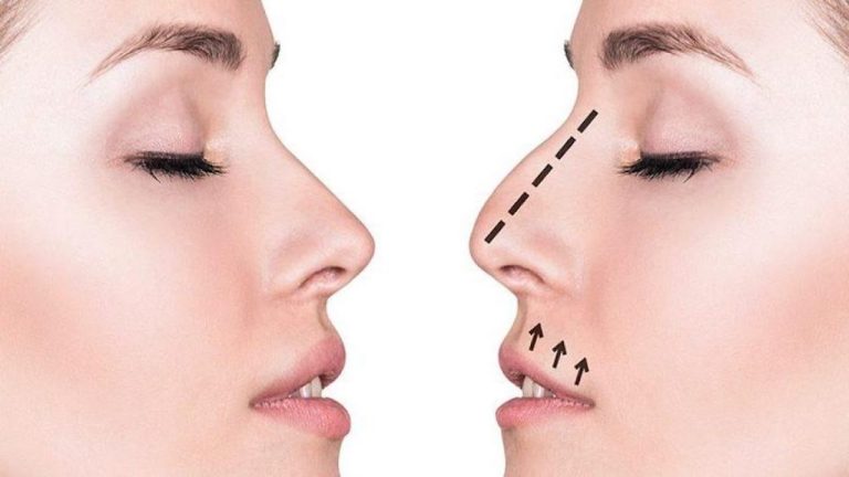Rimodellamento narici Milano