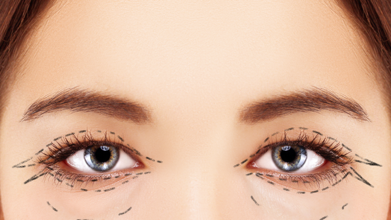 Fare blefaroplastica a Milano centro