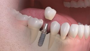 Prezzo per un impianto dentale Milano