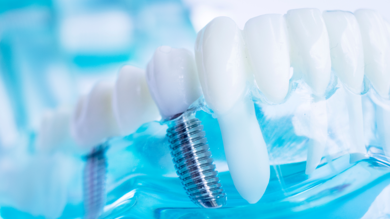 Implantologia informazioni Milano Implantologia informazioni Milano