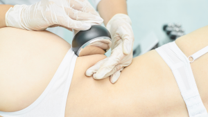 Laser lipolisi roma
